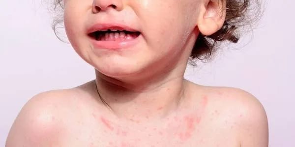 Bolehkah Anak Campak Mandi? Ini Jawaban yang Sering Disalahpahami Orang Tua