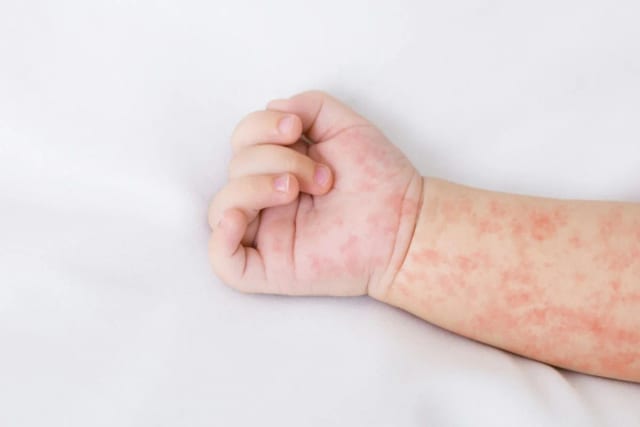 Campak Menular Berapa Hari? Ini yang Sering Salah Dipahami Orang Tua